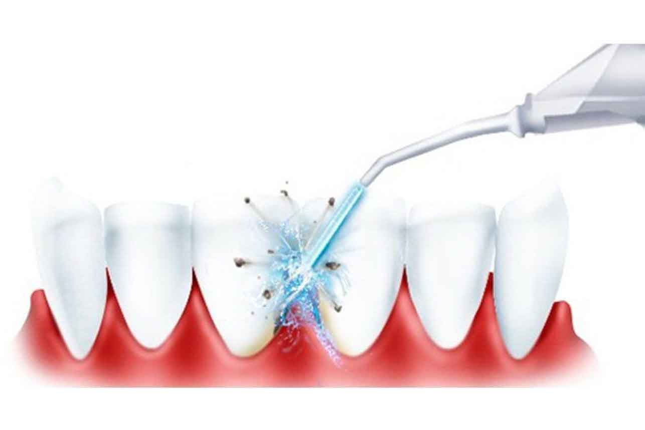 Кровоточивость десен после ирригатора отбеливание зубов что можно пить
